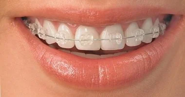مميزات وعيوب أنواع تقويم الأسنان: أيهما يناسبك؟