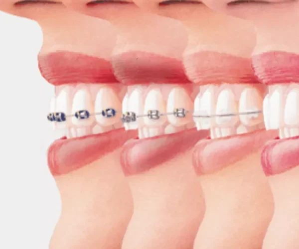 انواع تقويم الاسنان فى تبوك - مجمع العناية المتميزة الطبي