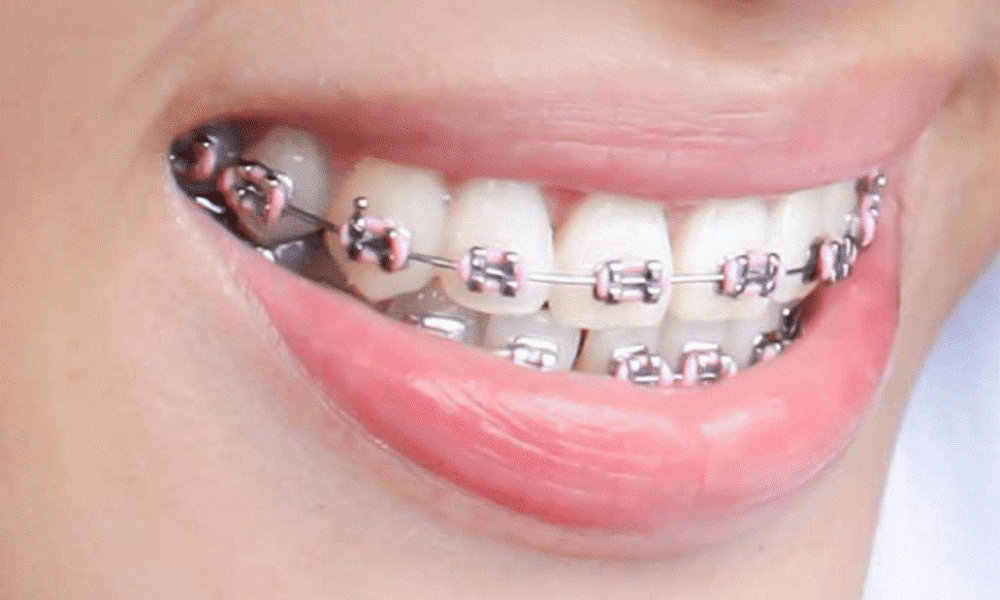 تقويم الأسنان