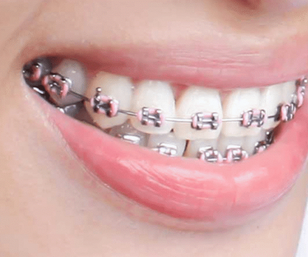 تقويم الأسنان