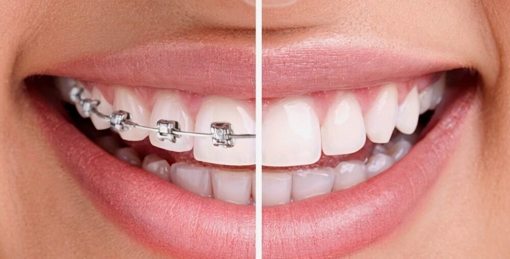 تقويم الأسنان فى تبوك