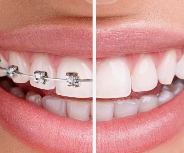 تقويم الأسنان فى تبوك