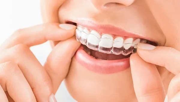 تقويم الاسنان الشفاف