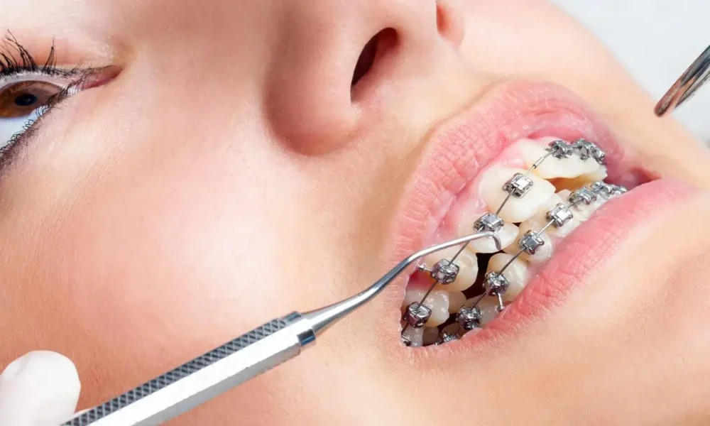 هل يتغير شكل الوجه بعد التقويم للاسنان - تبوك