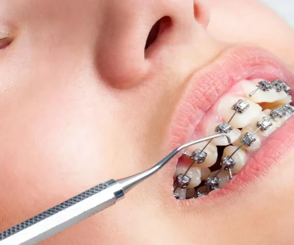 هل يتغير شكل الوجه بعد التقويم للاسنان - تبوك