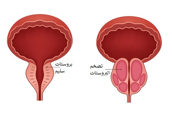 تضخم البروستاتا الحميد